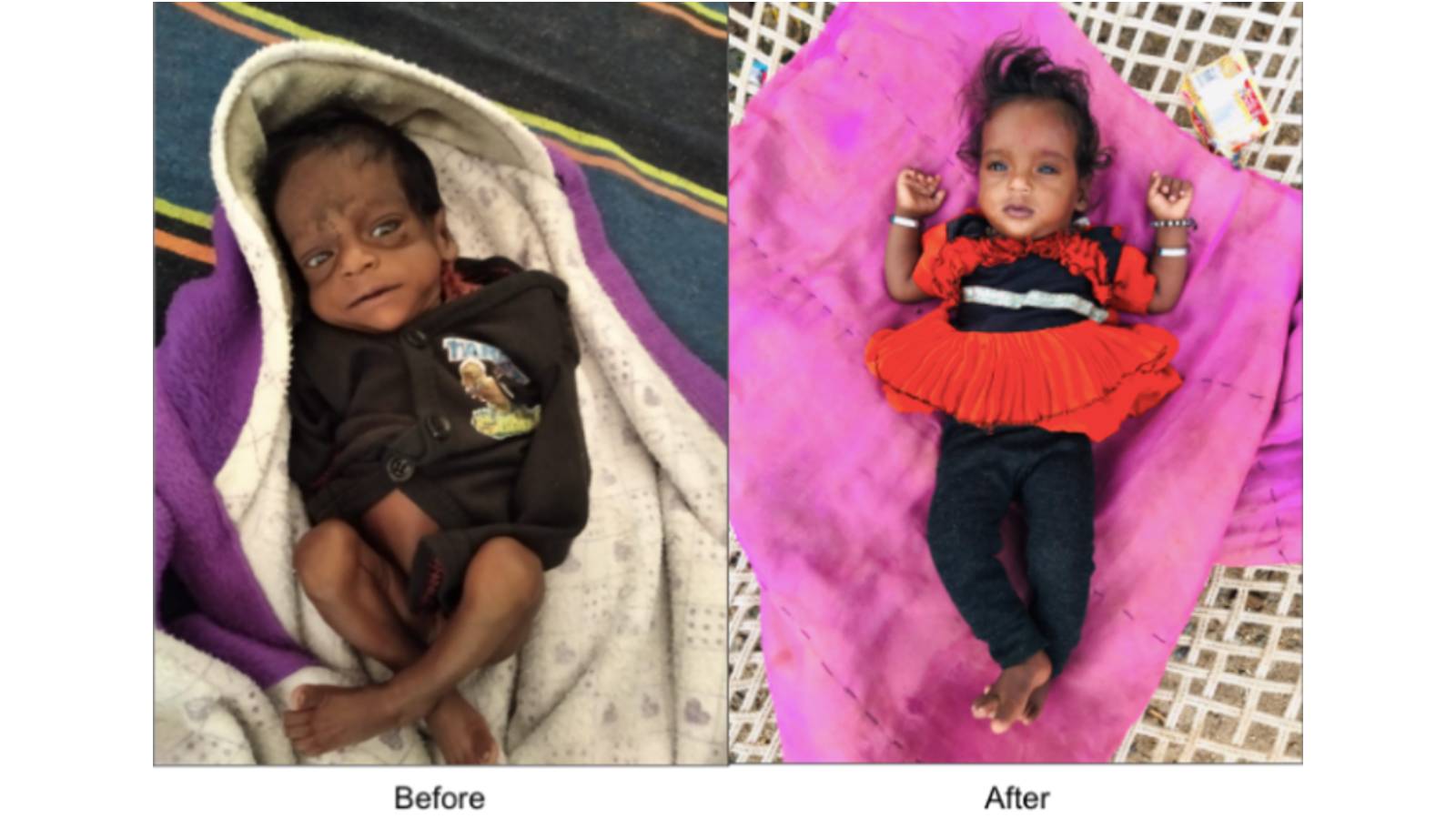 Home follow-up to malnourished children